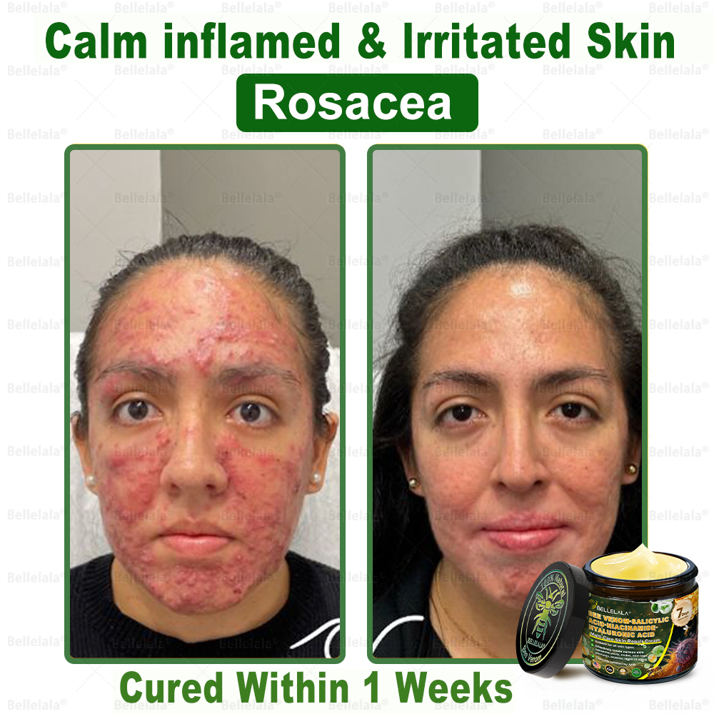 💎🇺🇸 Made & Shipped in the USA | Clinically Proven: Bellelala® Bee Venom Multi-Care Repair Cream with Melittin, salicylic acid, niacinamide, and hyaluronic acid, Vitamin C💧 Targets signs of aging, acne, scars, warts, psoriasis, dark spots, eczema and more.