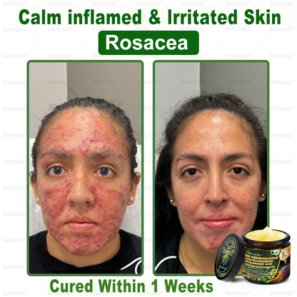 💎🇺🇸 Made & Shipped in the USA | Clinically Proven: Bellelala® Bee Venom Multi-Care Repair Cream with Melittin, salicylic acid, niacinamide, and hyaluronic acid, Vitamin C💧 Targets signs of aging, acne, scars, warts, psoriasis, dark spots, eczema and more.
