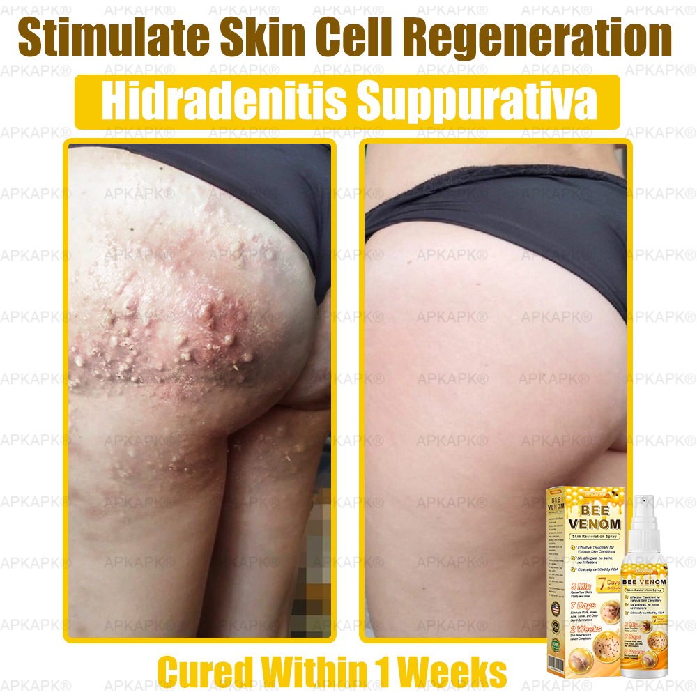 Instant Recovery🔥FDA Official: APKAPK® Bee Venom Skin Restoration Spray - Anti-aging, Hydrating, Skin Firming & Lifting, Skin Repair, Even Tone, Acne and Dark Spot Treatment, Wart and Mole Removal, and Psoriasis Relief.