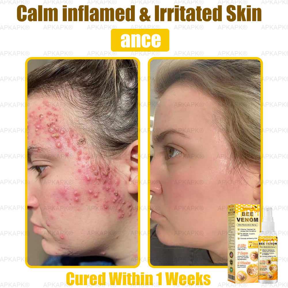 Instant Recovery🔥FDA Official: APKAPK® Bee Venom Skin Restoration Spray - Anti-aging, Hydrating, Skin Firming & Lifting, Skin Repair, Even Tone, Acne and Dark Spot Treatment, Wart and Mole Removal, and Psoriasis Relief.