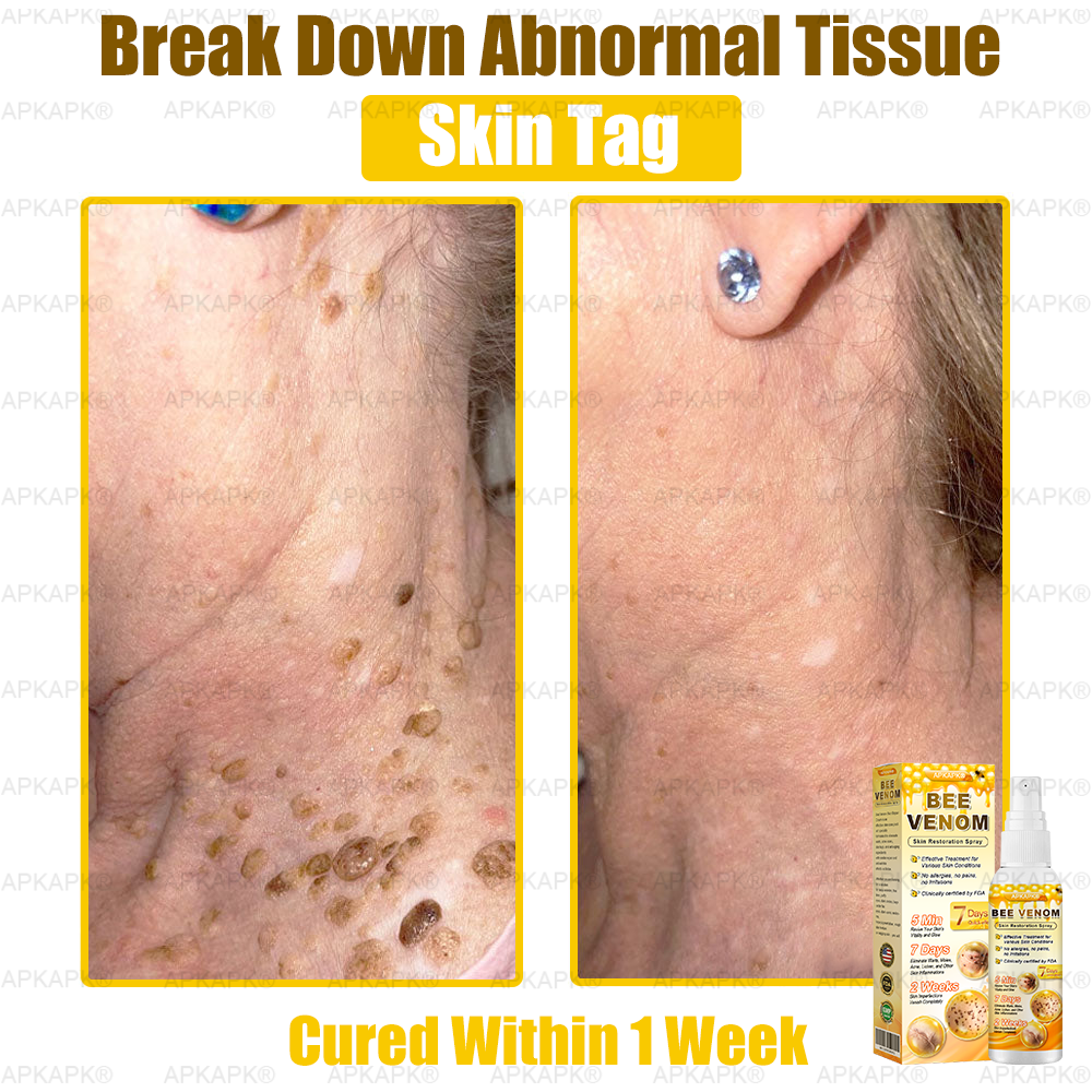 Instant Recovery🔥FDA Official: APKAPK® Bee Venom Skin Restoration Spray - Anti-aging, Hydrating, Skin Firming & Lifting, Skin Repair, Even Tone, Acne and Dark Spot Treatment, Wart and Mole Removal, and Psoriasis Relief.