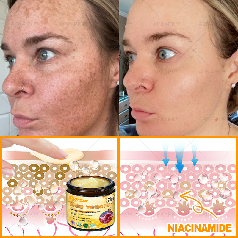 ✨✨ APKAPK® Bee venom Comprehensive Cream 🔥 Sagging Skin, Fine Lines, Loss of Firmness, Flat Bust, Drooping Hips, and More