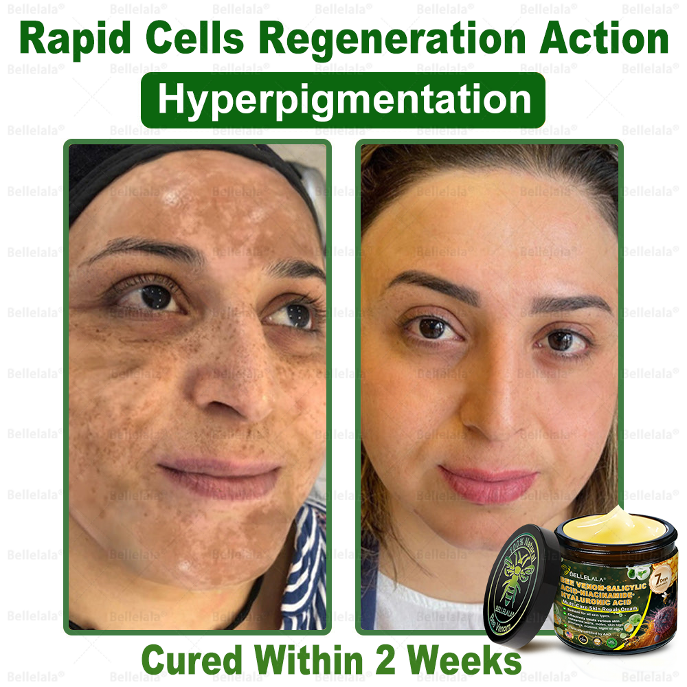💎🇺🇸 Made & Shipped in the USA | Clinically Proven: Bellelala® Bee Venom Multi-Care Repair Cream with Melittin, salicylic acid, niacinamide, and hyaluronic acid, Vitamin C💧 Targets signs of aging, acne, scars, warts, psoriasis, dark spots, eczema and more.