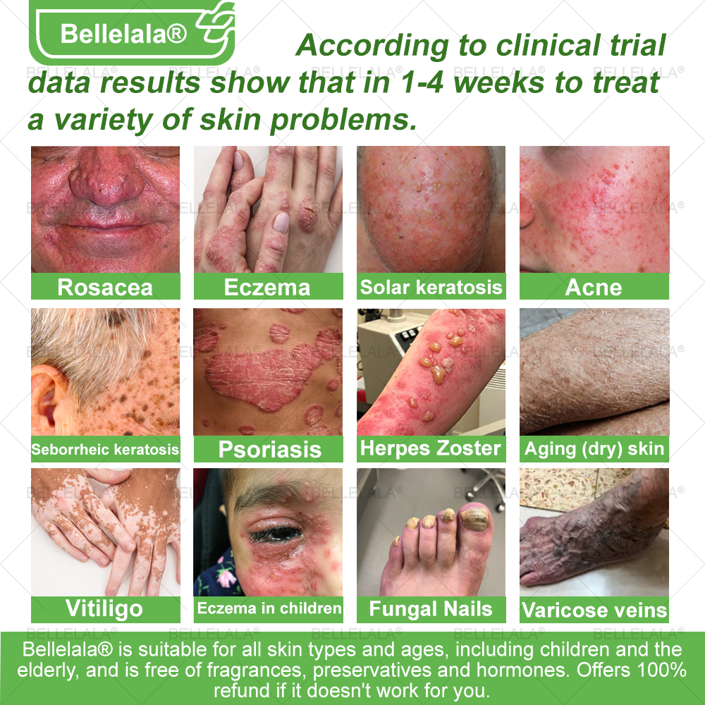 💎🇺🇸 Made & Shipped in the USA | Clinically Proven: Bellelala® Bee Venom Multi-Care Repair Cream with Melittin, salicylic acid, niacinamide, and hyaluronic acid, Vitamin C💧 Targets signs of aging, acne, scars, warts, psoriasis, dark spots, eczema and more.
