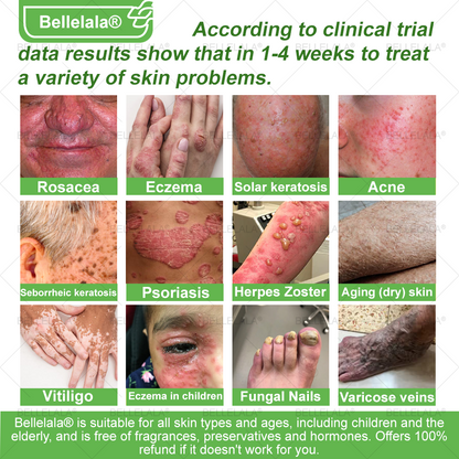 💎🇺🇸 Made & Shipped in the USA | Clinically Proven: Bellelala® Bee Venom Multi-Care Repair Cream with Melittin, salicylic acid, niacinamide, and hyaluronic acid, Vitamin C💧 Targets signs of aging, acne, scars, warts, psoriasis, dark spots, eczema and more.