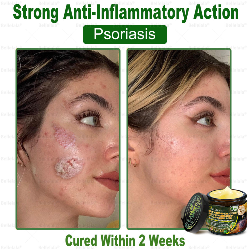 💎🇺🇸 Made & Shipped in the USA | Clinically Proven: Bellelala® Bee Venom Multi-Care Repair Cream with Melittin, salicylic acid, niacinamide, and hyaluronic acid, Vitamin C💧 Targets signs of aging, acne, scars, warts, psoriasis, dark spots, eczema and more.