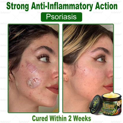 💎🇺🇸 Made & Shipped in the USA | Clinically Proven: Bellelala® Bee Venom Multi-Care Repair Cream with Melittin, salicylic acid, niacinamide, and hyaluronic acid, Vitamin C💧 Targets signs of aging, acne, scars, warts, psoriasis, dark spots, eczema and more.
