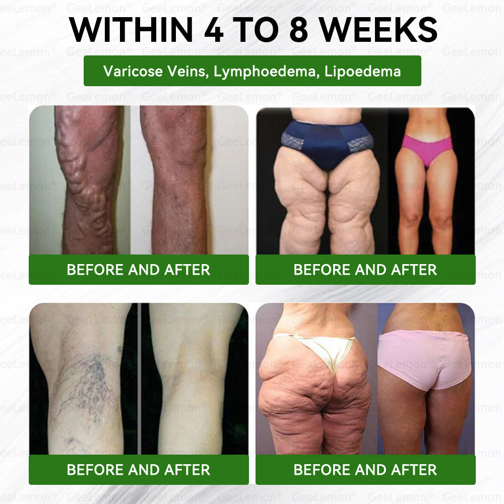 👩‍⚕️🎁𝐆𝐄𝐄𝐋𝐄𝐌𝐎𝐍® 𝐌𝐨𝐫𝐢𝐧𝐠𝐚 · 𝐀𝐌𝐏𝐊+𝐅𝐆𝐅𝟐𝟏 𝐍𝐚𝐧𝐨 𝐌𝐢𝐜𝐫𝐨𝐧𝐞𝐞𝐝𝐥𝐞 𝐏𝐚𝐭𝐜𝐡🇺🇸 (Just once a day, visible changes in 7 days) ✅ For obesity, loose skin, diabetes, and more.