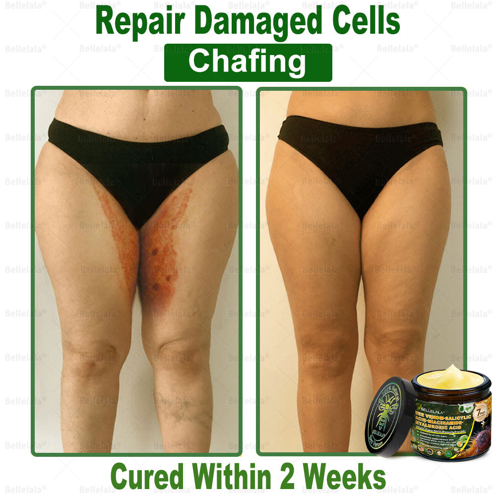 💎🇺🇸 Made & Shipped in the USA | Clinically Proven: Bellelala® Bee Venom Multi-Care Repair Cream with Melittin, salicylic acid, niacinamide, and hyaluronic acid, Vitamin C💧 Targets signs of aging, acne, scars, warts, psoriasis, dark spots, eczema and more.