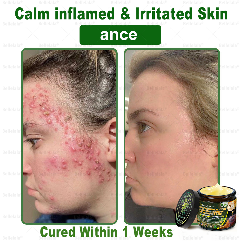 💎🇺🇸 Made & Shipped in the USA | Clinically Proven: Bellelala® Bee Venom Multi-Care Repair Cream with Melittin, salicylic acid, niacinamide, and hyaluronic acid, Vitamin C💧 Targets signs of aging, acne, scars, warts, psoriasis, dark spots, eczema and more.